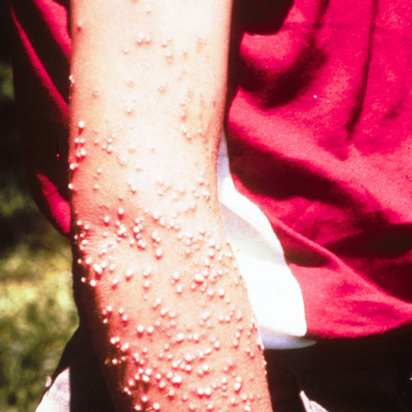 Injury caused by Red Imported Fire Ant