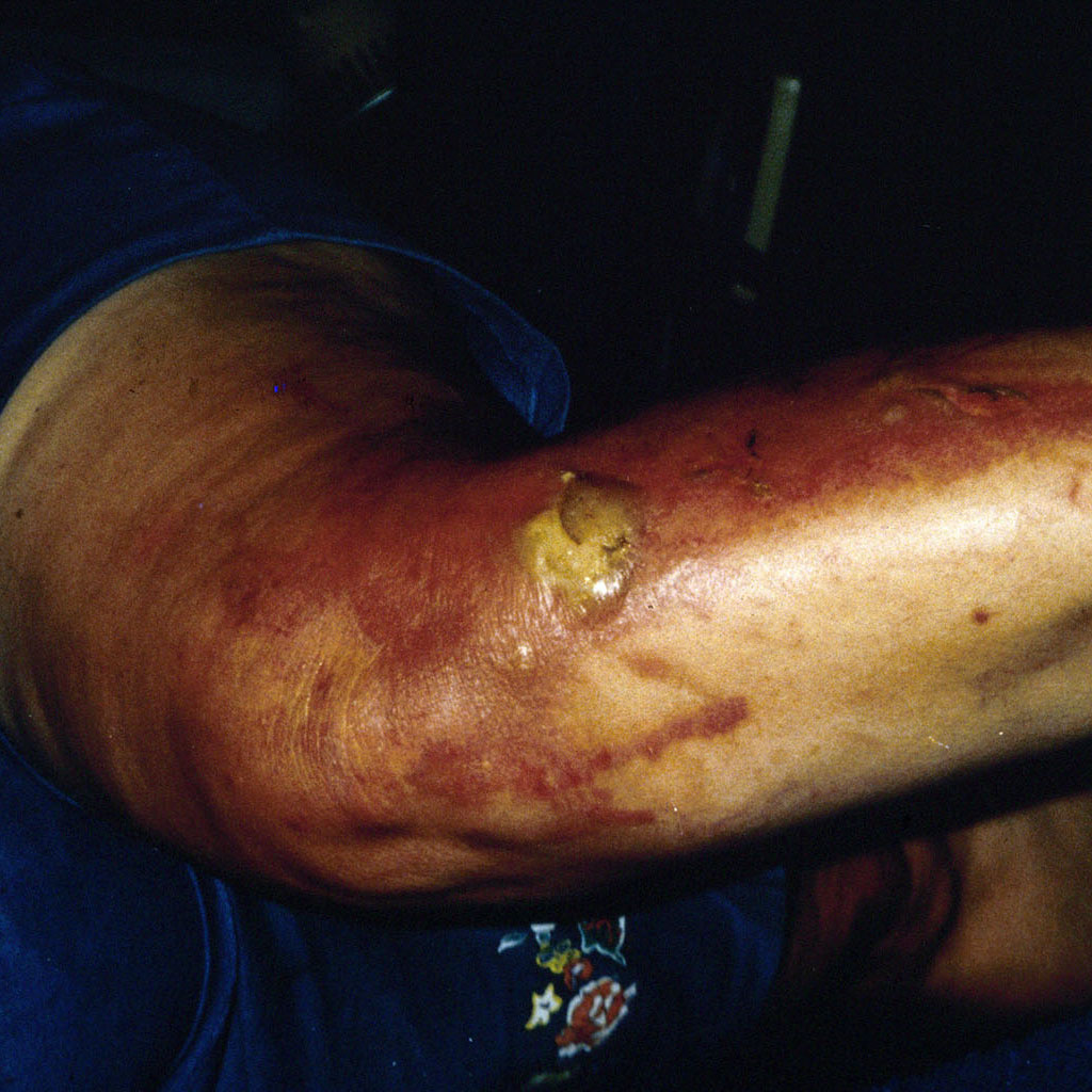 Photo of a person's forearm with large yellow sore from a burn caused by giant hogweed.